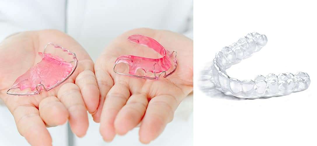 ก่อนจัดฟัน หลังจัดฟัน เตรียมตัวอย่างไร เรื่อง รีเทนเนอร์ Retainer